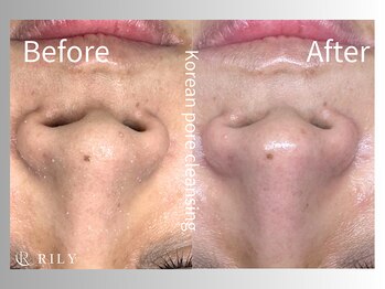 リリー(RILY)/【毛穴洗浄ビフォーアフター】