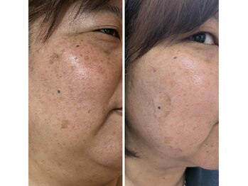 サロン アンネ(Anne)/剥離*ありハーブピーリング