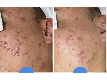 ツヤハダコガオ 千葉店/before⇒after 【プラズマ】