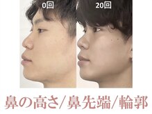 ラプリシュシュ 岡山店(Raplit)/隆鼻＋輪郭矯正40分20回