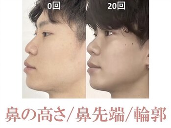 ラプリシュシュ 岡山店(Raplit)/隆鼻+輪郭矯正40分20回