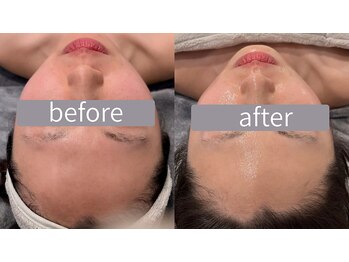 リズ(rE:S)/韓国インモードリフティング20代