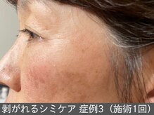 オアシスラグーン(OASIS LAGOON)/シミケア（症例3 施術1回）60代