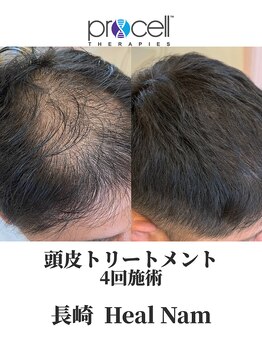 ヒルナム(Heal Nam)/~プロセルセラピーズ~頭皮