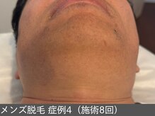 オアシスラグーン(OASIS LAGOON)/メンズ脱毛（症例5 施術8回）