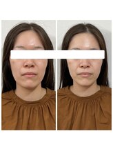 ブランソワン/ほうれい線がお悩みでした