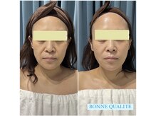 ボンヌカリテ(BONNE QUALITE)/wishpro BTX施術写真