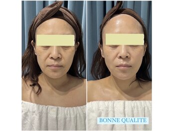 ボンヌカリテ(BONNE QUALITE)/wishpro BTX施術写真