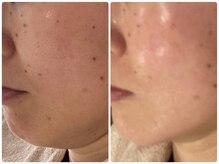 ノーブル シャット Noble Chate/小顔コースではないけれど・・