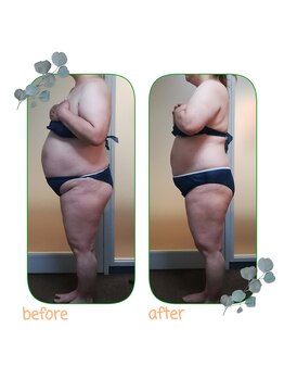 ダイエット サポート(DIET SUPPORT)/グロッティ 腹部 施術結果