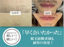みんなの脱毛 ツルリン(TSURURIN)/施術例【脱毛/市川/千葉】