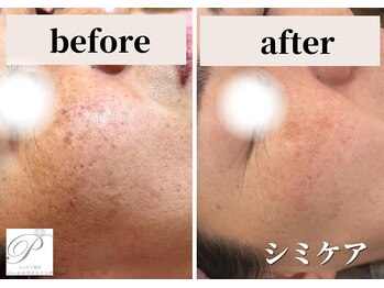 パールホワイトニング/出産後に濃くなったシミ改善