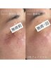 リピーター様人気No.1【シミ美白】光フェイシャルplus＋毛穴洗浄or美容液導入
