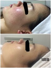 ビズビズ 天王寺店(bisebise)/ニキビ/毛穴開き黒ずみ角栓詰り