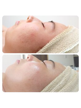 アンティクイーン(Antiqueen)/ごわついたお肌、ハリと艶肌へ