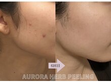 アイル(iru)/自社製造のAURORA Herb Peeling