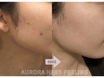 アイル(iru)/自社製造のAURORA Herb Peeling