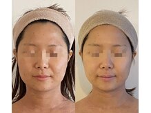 ラスティック(rustique)/小顔、リフトアップにも効果絶大