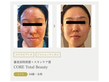 まりも化粧品店/ホワイトスノーピール