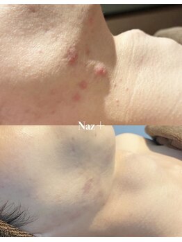 リベルテ(Liberte)/セレクトニキビケア管理