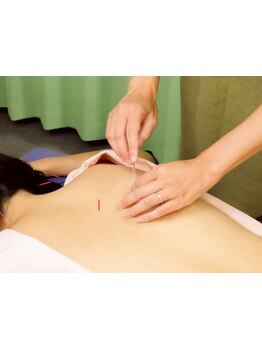 鍼灸施術を受けたい