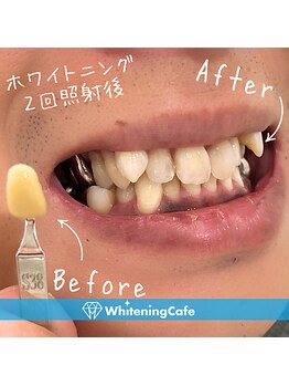 ホワイトニングカフェ 池袋東口店/ホワイトニングビフォーアフター