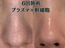 【プラズマ×幹細胞原液100%】毛穴/しわ/たるみ/シミ/表参道