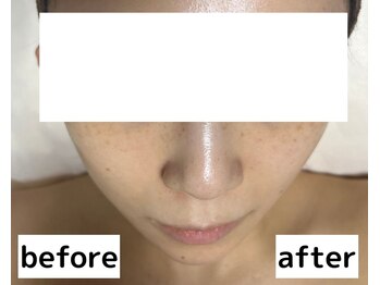 ライム 錦糸町(LIME)/Before/After