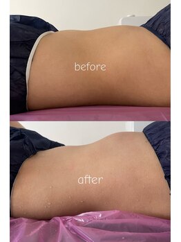 キララ(Kirara)/ホルミシス温活の効果