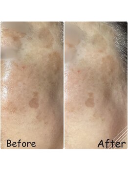 泡のきもち/【美肌ケア】1回目の施術後