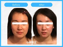 トウメイコガオ 横浜店/トウメイコガオで小顔エステ