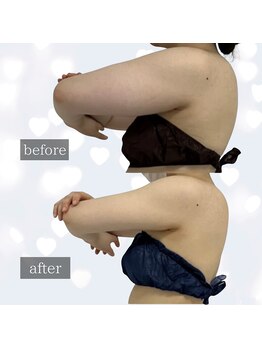 プリマルーチェの写真/【冷やすだけで終わらせない】二の腕・背中のハミ肉を体外排出！独自アフターケアで華奢見えボディへ