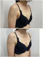 バーディー(BIRDIE)/施術１回/２０代