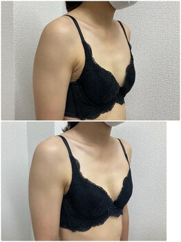 バーディー(BIRDIE)/施術１回/２０代