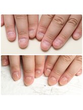 エヌスタイル(N-STYLE)/深爪改善ケア