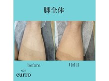 アクト クロ(ACT curro)/【脚全体】脱毛施術例