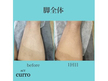 アクト クロ(ACT curro)/【脚全体】脱毛施術例