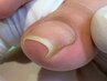 オススメ【巻き爪・陥入爪補正２ヵ所】+【足の爪切りセット】12,650→11,000