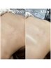 【ワックス脱毛】美肌背中ワックス脱毛