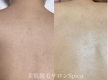 スピカ(SPICA)/背中も即日綺麗に！