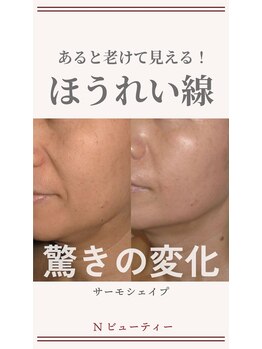 Nビューティー/最新RFサーモシェイプオーパス