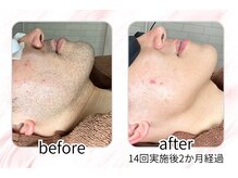 イチキュービー 仙台駅前東口店(19B)/男性のひげ脱毛の経過