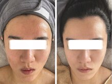 香嬉琉/リフトアップ，小顔ケア