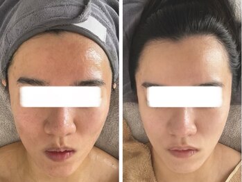 香嬉琉/リフトアップ，小顔ケア