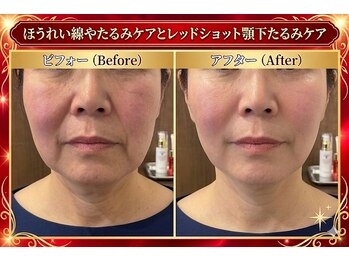 ラシクビューティールームの写真/30代からの食いしばり・たるみケア・フェイスライン・ほうれい線に
