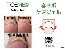 リボーンネイル 坂戸店(Re Born Nail)の雰囲気（巻き爪のお悩み解消♪ジェルで出来る巻き爪ケア☆詳細はブログへ）