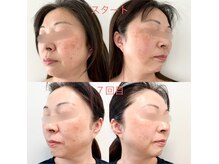 ミコ(Mico)の雰囲気（当店自慢のピーリング☆しっかりと効果を感じて頂けます。）