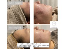 ラヴィオーラ 川崎(La Viora)/ダイヤモンドハーブピーリング