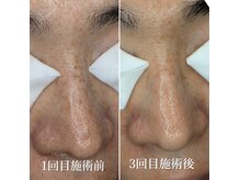 毛穴ケア×ハーブピーリングで圧倒的変化！