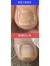 【フット】自爪育成コース